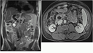Figure 4: Side-branch type IPMT. Coronal T2-weighted single shot echo trains spin echo (A) and axial post-gadolinium fat-suppressed T1-weighted gradient echo (B) images demonstrate mainly large cystic side branch lesion in the head of the pancreas.